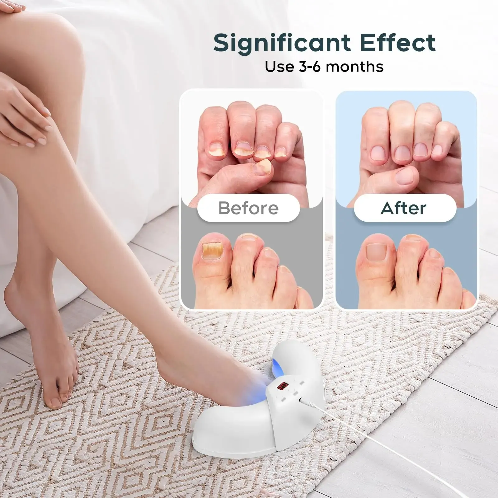 Nail Fungus Laser Device – Multi-Nail Treatment for Home Use